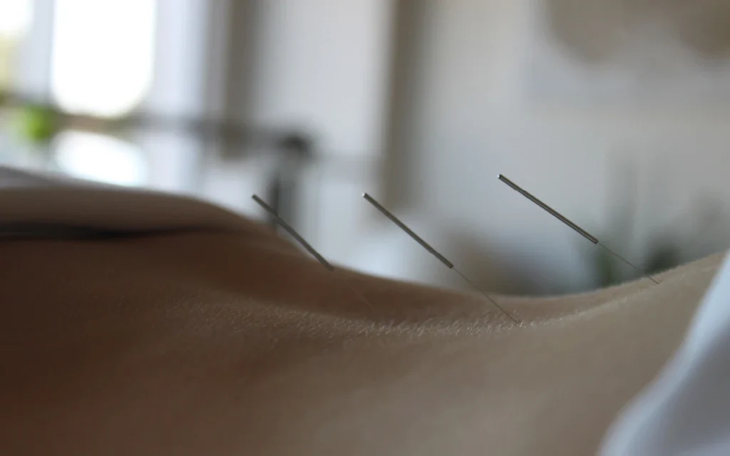 neurocore physiotherapy - accupuncture