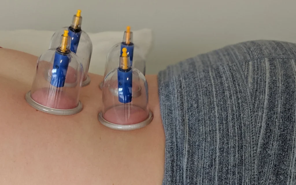 neurocore physiotherapy - cupping